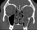 Orbital blowout fracture