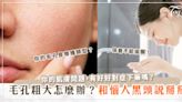 惱人的毛孔粗大及黑頭粉刺怎麼改善？醫師分享保養步驟！