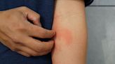 5 Hormonal Changes That Could Trigger Eczema