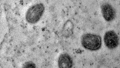 OMS expressa preocupação por nova cepa da varíola dos macacos
