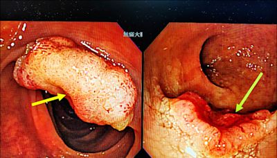 一年暴瘦10公斤 驚見大腸「雙腫瘤」 - 自由健康網