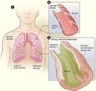 Bronchiectasis