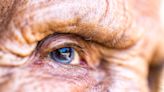 What Are Cataracts?