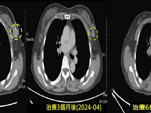 最難纏「HER2陽性乳癌」易轉移復發！健保最新給付省百萬 提升存活率