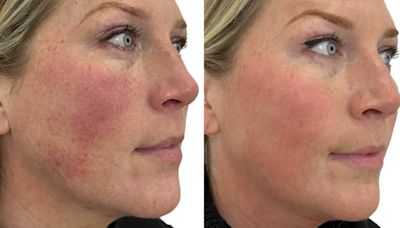 Women are raving about a 'quick and easy' skin treatment