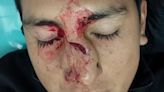 Brutal agresión a un árbitro en Salta: tras sacarle amarilla, le dio un cabezazo en la cara y le fracturó la nariz