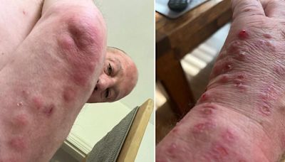 Dad left with red itchy bites after buying 'second hand' sofa from ScS