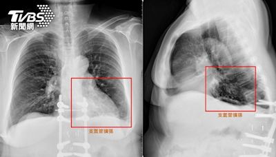 五旬婦從不抽菸咳出血絲 醫一查支氣管「塞滿黃痰」患這病│TVBS新聞網