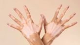 Día Mundial del Vitiligo: cuatro claves sobre esta condición que afecta la pigmentación de la piel
