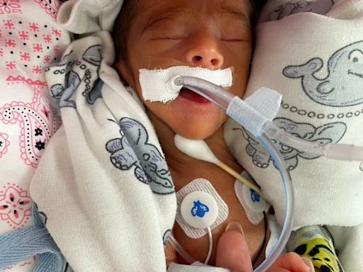 26週出生體重僅880公克 聖保祿醫院最小早產兒健康出院 - 自由健康網