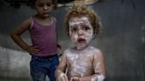 Lice, scabies, rashes plague Palestinian children as skin disease runs rampant in Gaza’s tent camps