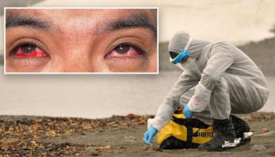 Texas farmer diagnosed with bird flu from cow had intense eye bleeding, gross new photo shows