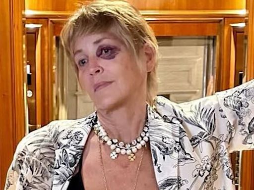 Sharon Stone reveals HOW she got that black eye
