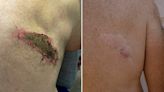 La peligrosa picadura de la avispa asiática: “Me ardía toda la espalda. Han pasado dos años y todavía tengo la cicatriz”