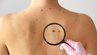 Cirugía de MOHS: el tratamiento para el cáncer de piel que tiene mayor tasa de curación y pocos lugares realizan