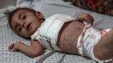 Photos: Dangerous skin diseases spreading among children in Gaza