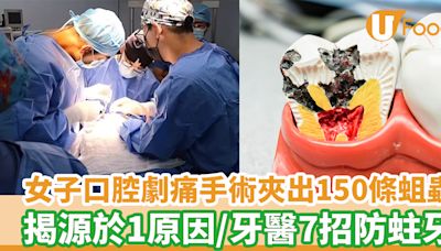 女子口腔劇痛手術夾出150條蛆蟲 揭源於1原因 附牙醫7招防蛀牙 | U Food 香港餐廳及飲食資訊優惠網站