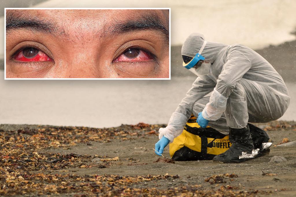 Texas farmer diagnosed with bird flu from cow had intense eye bleeding, gross new photo shows