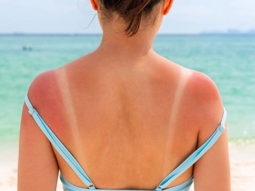 Scottish redhead reveals her go-to cure for soothing sunburn overnight