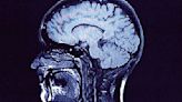 Testing can help identify stroke risk