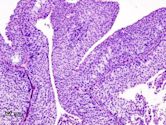 Transitional cell carcinoma