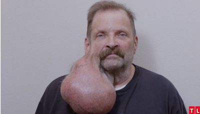 男子耳邊生頑強小粉刺 16年後長成「2.5公斤巨瘤」！