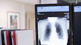 What Is a Chest X-Ray?