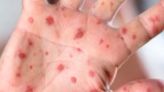 Measles cases double worldwide