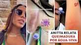 Anitta relata queimadura por água-viva: 'Uma dor nunca antes experimentada'