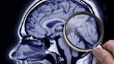 Enigmático circuito: describen los presuntos primeros casos de transmisión del Alzheimer a través de inyecciones