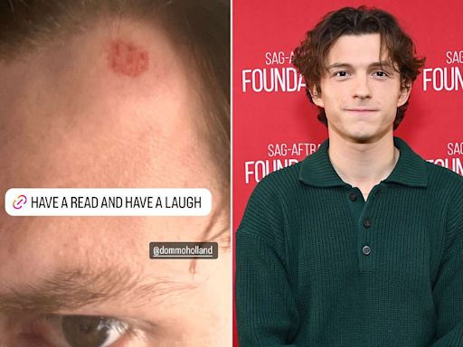 Tom Holland Shares Image of Painful Head Injury from Family Golf Day: ‘You Can Almost See the Dimples’