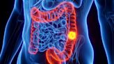 Este es el síntoma más común de cáncer de colon, pero lamentablemente muchos lo ignoran