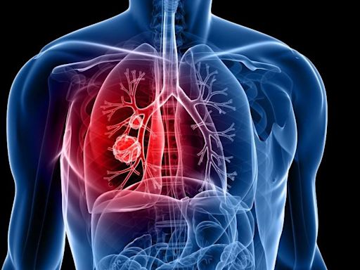Lung Cancer spreads to brain silently, causes major concern