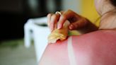 "It's A Bad Sign": How To Know If Your Sunburn Needs Medical Attention, According To Doctors