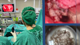 泰國婦鼻塞頭痛一星期求醫 手術揭鼻腔藏上百條蛆蟲 | am730