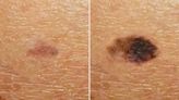 Alarming time-lapse video reveals how tiny 'dark patch' morphs into melanoma