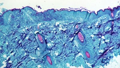 Bavarian Nordic planeja ampliar produção de vacinas contra mpox Por Poder360