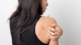 Should you see a doctor for that skin rash? Experts share advice and home treatments