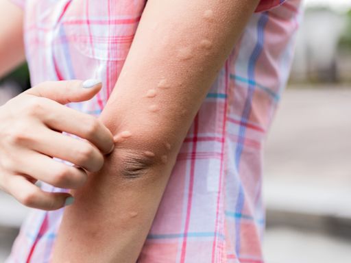 Here's how to stop mosquito bites from itching, according to the experts