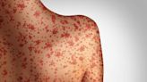 Ottawa County Health Department recommends measles precautions | Newsradio WOOD 1300 and 106.9 FM | WOOD Radio Local News