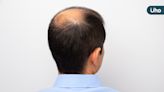 全台統計超過五千人受圓形禿所苦 臺灣研究皮膚科醫學會將舉辦毛髮論壇