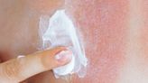 My sunburn cure is more than just aloe vera - people call it 'witchcraft'