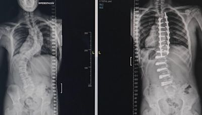 El hospital La Fe de Valencia corrige una desviación de columna con una intervención pionera en España