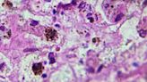 New cell-based therapy for melanoma more effective than existing treatment, trial finds