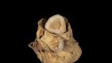A tumor with teeth was found in the pelvis of an ancient Egyptian woman, along with a ring to protect her from pain