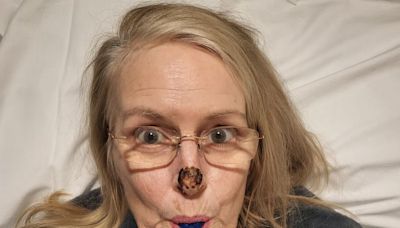 'Flesh-eating bug ate away at my nose - baking soda saved my life'