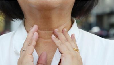 女大生體檢查出甲狀腺結節勇敢切除 醫揭1年齡層女性好發 - 健康