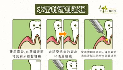 牙周病治療新福音 水雷射可深層滅菌又不怕牙齦大幅萎縮