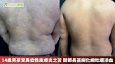 14歲男孩受異位性皮膚炎之苦 關節長苔癬化病灶還滲血