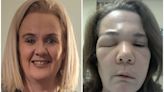 ‘I looked like The Elephant Man’: Life with extreme swelling disease HAE